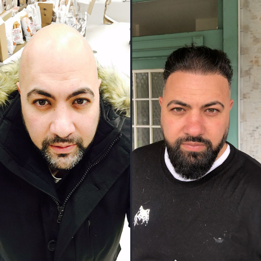 DHI Hair Transplant Result 5800 Follicles DHI Hair transplant 12 Month Result