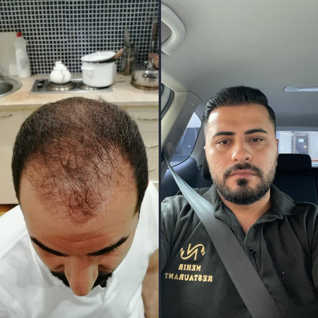 DHI Hair transplant 12 Month Result 5200 Follicles DHI Hair transplant 12 Month Result