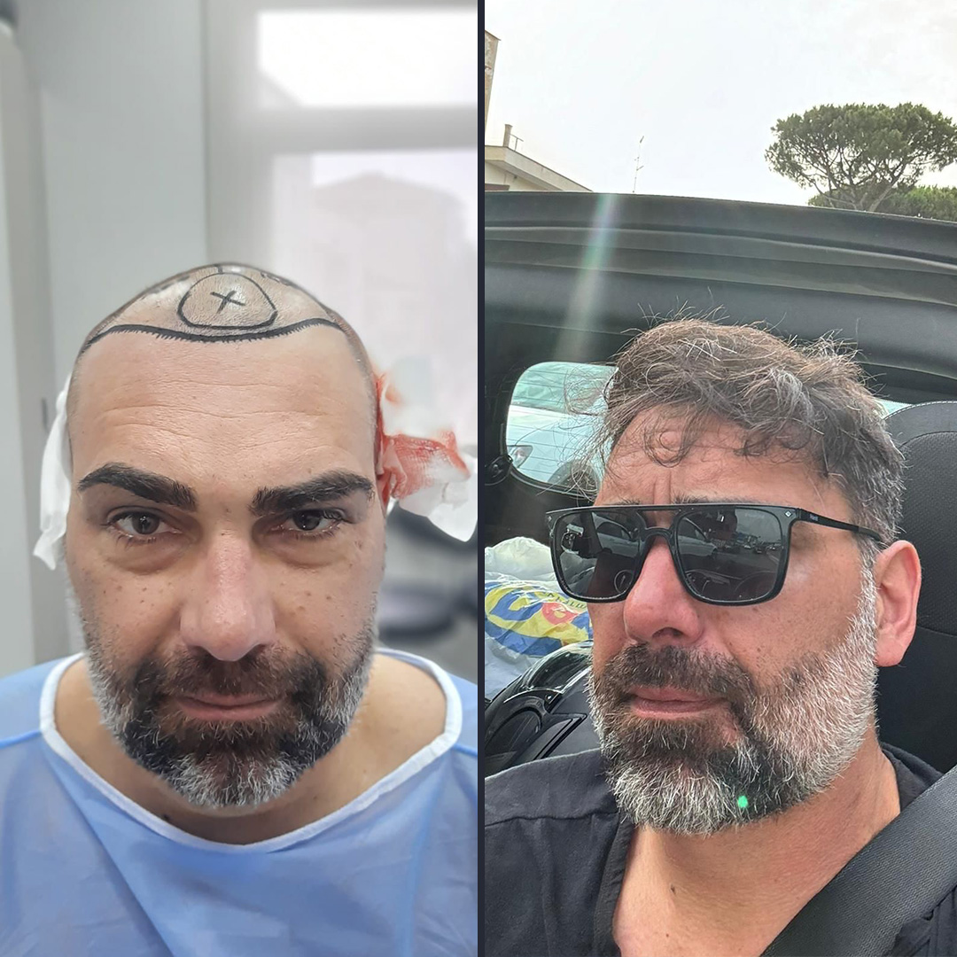 DHI Hair transplant 12 Month Result 4400 DHI Hair transplant 12 Month Result